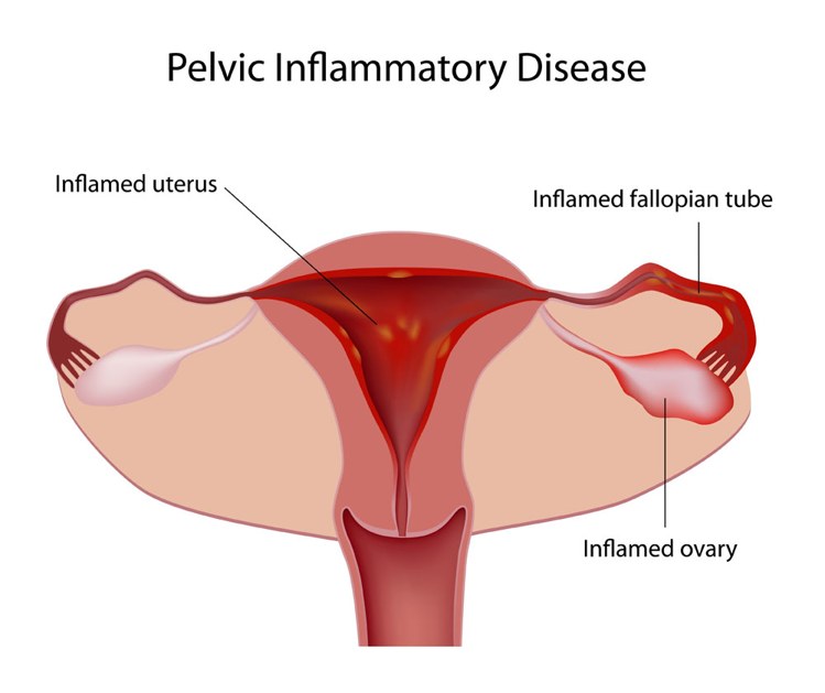 पेल्विक इन्फ्लैमटोरी डिजीज़ (Pelvic inflammatory disease)